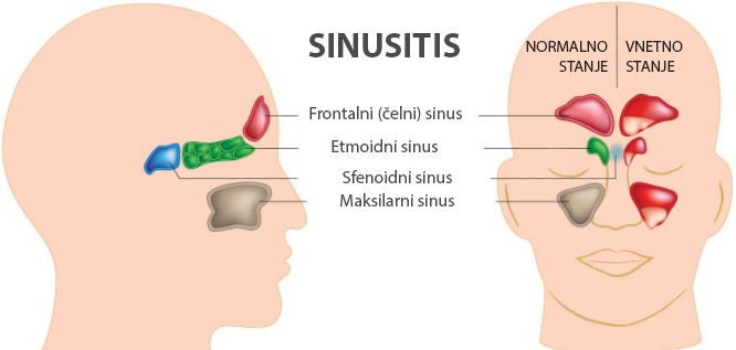 Infografika sinusitisa